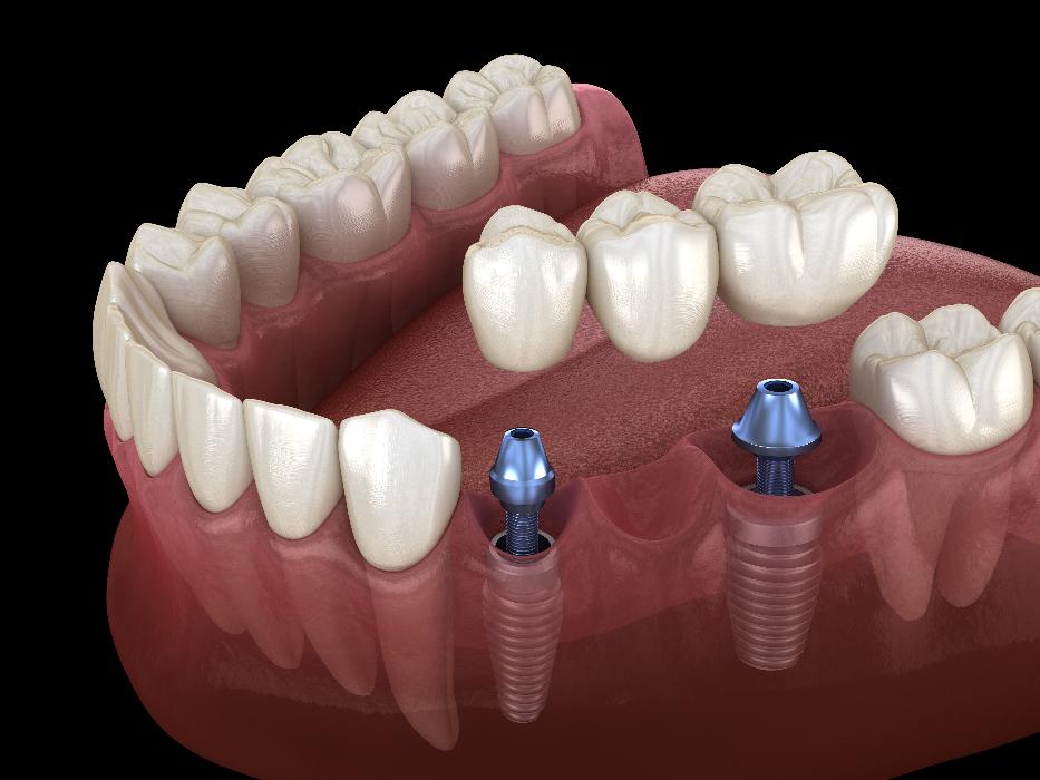 dental bridge in mouth | dental crowns high point nc