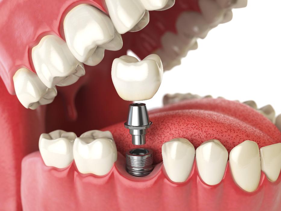 single implant in lower jaw | dental implants high point nc