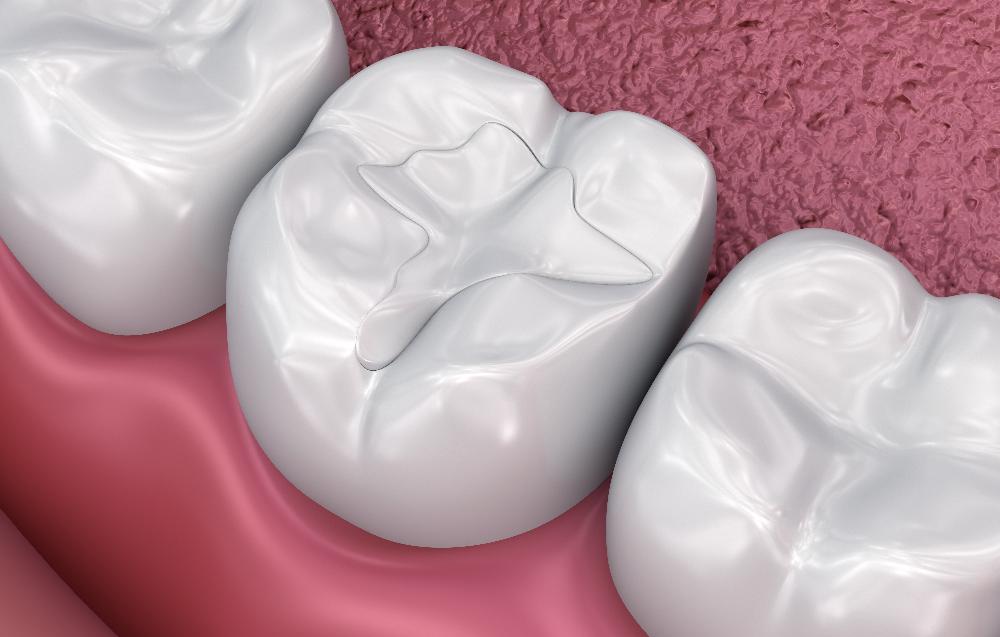 close up of tooth colored fillings | tooth colored fillings high point nc