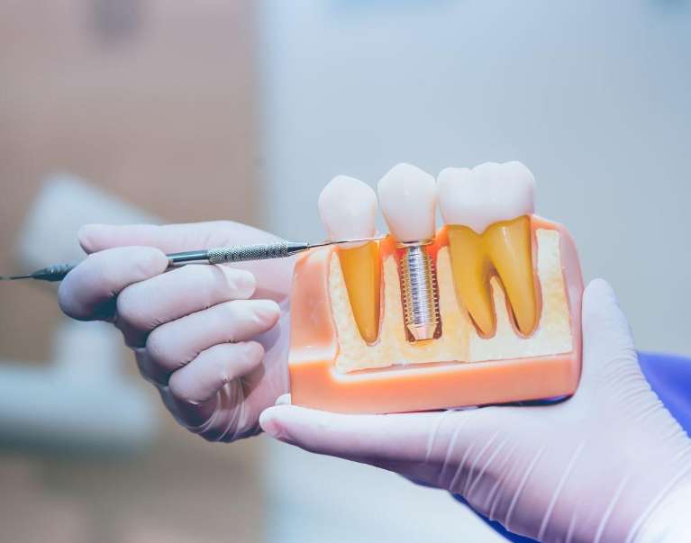 model of implant in jaw model | dental implants high point nc