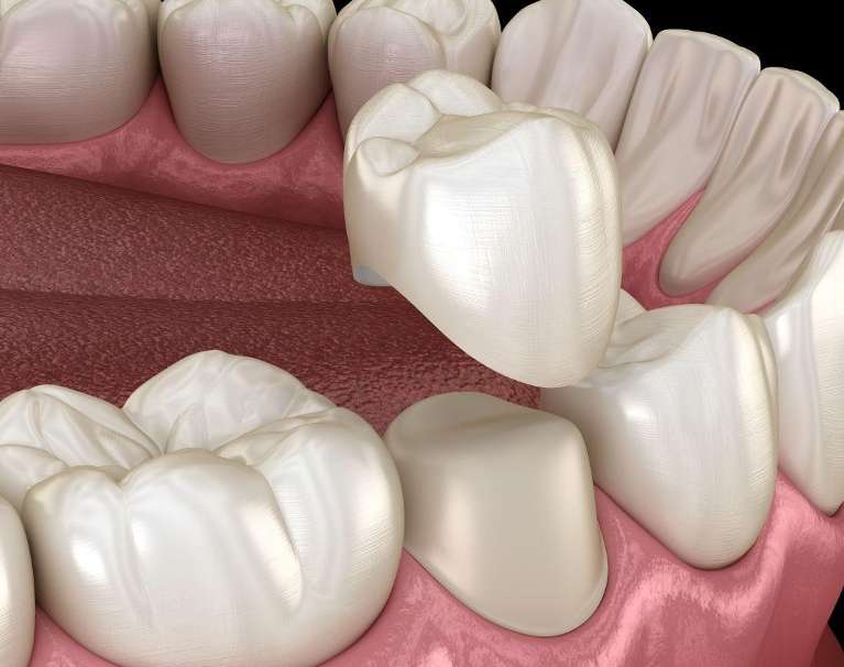 dental crown on tooth in jaw | dental crowns high point nc