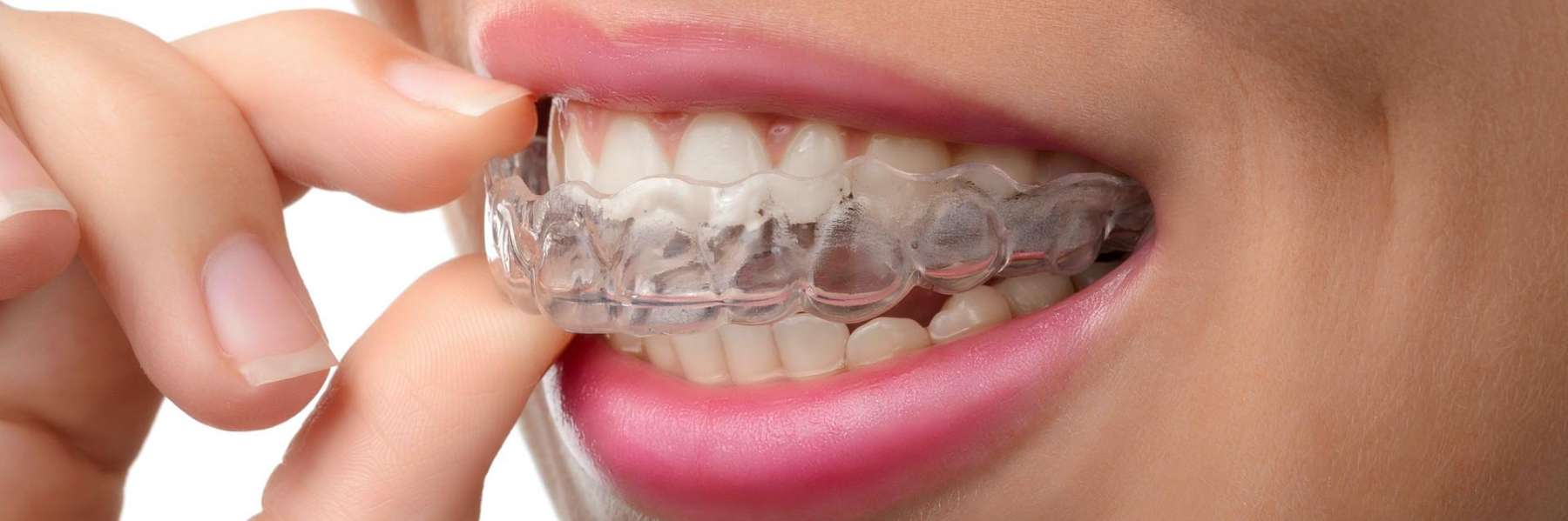 patient putting in clear plastic aligner | high point dentist